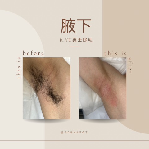 R.yu男士除毛 - 你也不喜歡舉手時毛毛跑出來嗎？
那就來R.vu預約除毛吧