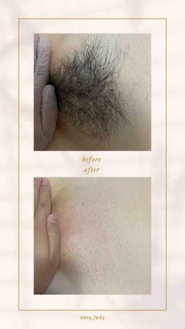 SL除毛室 - 私密處全除