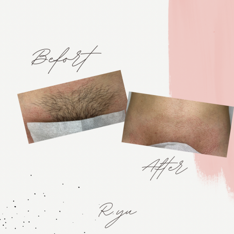 R.yu男士除毛 - 誰說男生不能乾淨溜溜

你也常常感覺下面悶悶熱熱的嗎
快來預約除毛，讓你不再悶熱搔癢