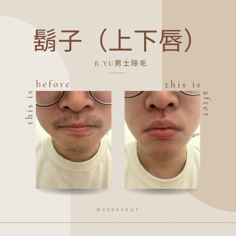 R.yu男士除毛 - 你也跟我一樣鬍子長得很快嗎
晚上刮完睡一覺他又長出來了?‍♂️
刮到真的很懶嗎?
那就來預約拔鬍子吧