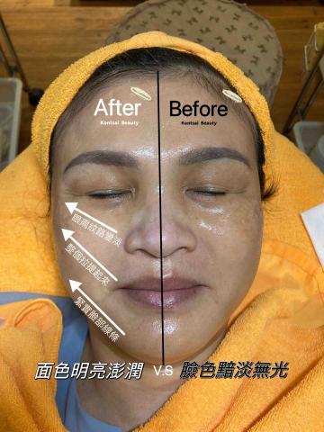 🔅靖雯撥筋護膚師🔅 - V臉淨白課程