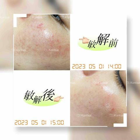 🔅靖雯撥筋護膚師🔅 - 敏感肌修護課程