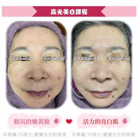 🔅靖雯撥筋護膚師🔅 - 高光美白課程
