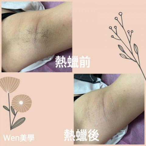 wen美學 - 腋下熱蠟美肌