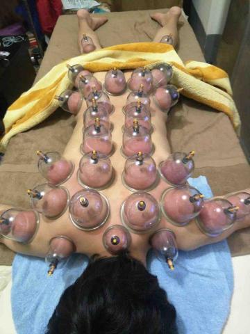 Momo - 拔罐