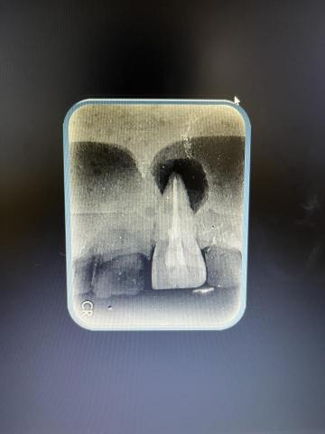 賴宏洋 - 最有興趣的根管治療