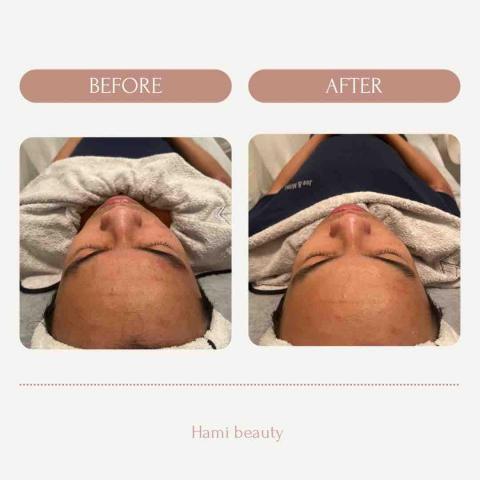 hami beauty - 清粉刺