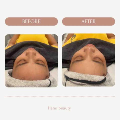 hami beauty - 清粉刺