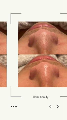 hami beauty - 清粉刺