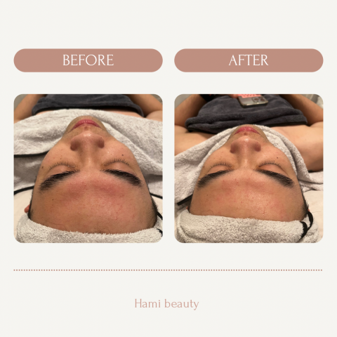 hami beauty - 清粉刺