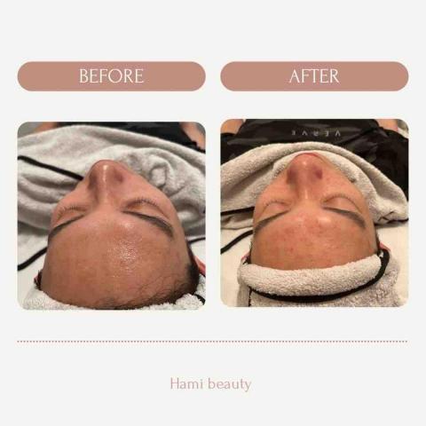 hami beauty - 清粉刺