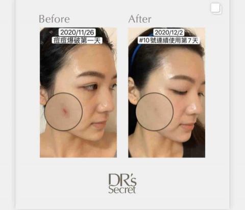 Jasper - 10號是補水的,有些皮膚造成痘痘的形成,也可能是太乾,所引起的,我們會看妳的皮膚,給與最好的保養,也有再生細胞的3號,讓妳的傷口不要留下疤痕 Jasper - 10號是補水的,有些皮膚造成痘痘的形成,也可能是太乾,所引起的,我們會看妳的皮膚,給與最好的保養,也有再生細胞的3號,讓妳的傷口不要留下疤痕