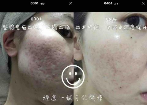 Jasper - 常見的痘痘肌,凹疤坑洞
都是日常沒有做好清潔跟防曬
或是手沒有感覺,去摳她造成的
我們靠著每天日常保養
就能改善妳的皮膚
讓皮膚修護回最原始最漂亮的肌膚
不用靠外力破壞,只解決到表面問題,我們可以達到深層清潔,真的幫你疏通毛孔
還不趕快私訊詢問肌膚?
有擦保養品,還是讓皮膚有差別的保養品
有沒有差,皮膚會說話 Jasper - 常見的痘痘肌,凹疤坑洞
都是日常沒有做好清潔跟防曬
或是手沒有感覺,去摳她造成的
我們靠著每天日常保養
就能改善妳的皮膚
讓皮膚修護回最原始最漂亮的肌膚
不用靠外力破壞,只解決到表面問題,我們可以達到深層清潔,真的幫你疏通毛孔
還不趕快私訊詢問肌膚?
有擦保養品,還是讓皮膚有差別的保養品
有沒有差,皮膚會說話