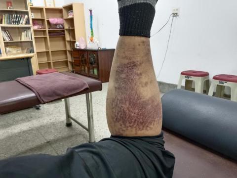 光明  傳統整復推拿 - 林藥師 四十幾年的糖尿病 