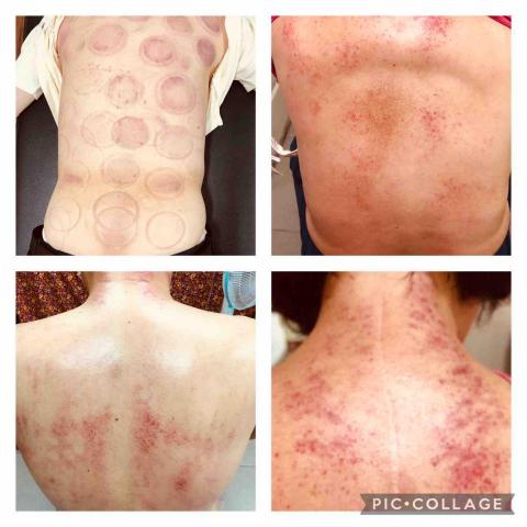 知足見康手足浴館 - 李氏砭法、拔罐調理