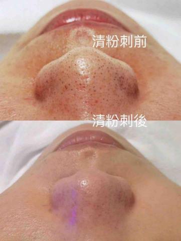 王宥尹美容Spa - 清粉刺完全無痛，無修復期