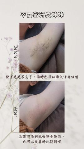 Baby's Breath Studio - 夏天天氣悶熱，別再遮遮掩掩穿長袖不透氣的衣服了
腋下除毛不但美觀提升之外，排汗也沒煩惱
若是有狐臭的困擾，去除腋下毛髮也可以降低狐臭困擾唷~~