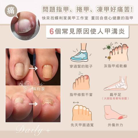 蝶利家美甲工作室 - 手部足部問題指甲/卷甲/凍甲/扇行指甲/飛甲