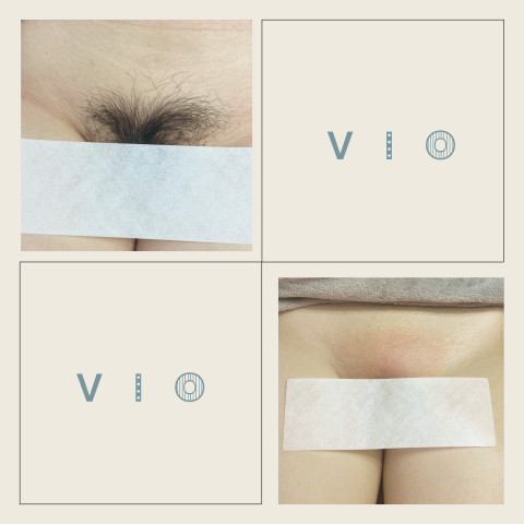 Artmiss_hotwax - 熱蠟VIO全除