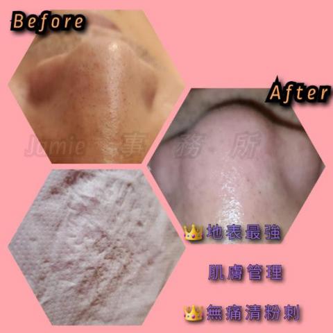 KiKi技導/美容師 - 無痛清紛刺 KiKi技導/美容師 - 無痛清紛刺