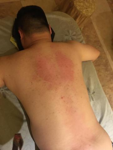 QQ工作室 - 老煙槍，光是鬆筋踩背五分鐘的時間，背部出現（明顯紅色）肺部?樣貌，此為肺部功能已經異常，煙少抽了吧！心血管疾病高風險的人，雖然肩頸暫時不會痠痛，但按摩並不會幫助延長壽命！養生終究還是只能靠自己！！