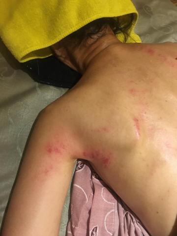 QQ工作室 - 新手媽咪，照顧新生兒，又是哺乳又是日夜不停歇，肩頸僵硬、雙臂痠痛，要求加強揉捏肌肉而不是大力刺激點壓、訴求為放鬆肩胛骨就自然出痧，經過開背穴，有種莫名解脫的輕鬆感，開心的媽咪才有開心健康的寶寶?