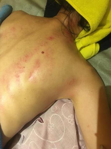 QQ工作室 - 新手媽咪，照顧新生兒，又是哺乳又是日夜不停歇，肩頸僵硬、雙臂痠痛，要求加強揉捏肌肉而不是大力刺激點壓、訴求為放鬆肩胛骨就自然出痧，經過開背穴，有種莫名解脫的輕鬆感，開心的媽咪才有開心健康的寶寶！！