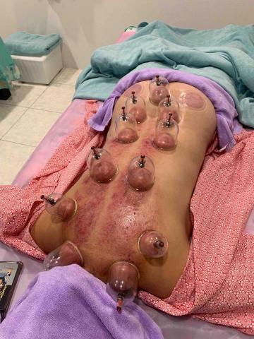 摩藝屋-傳統整復推拿｜骨盆回正訓練｜ - 刮痧拔罐調理