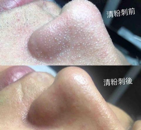 王宥尹美容Spa - 王宥尹美容Spa專業無痛清粉刺前後對比