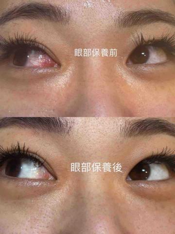 王宥尹美容Spa - 王宥尹美容Spa的眼部保養前後對比舒緩眼壓改善眼睛疲勞，黑眼圈讓眼睛明亮有神