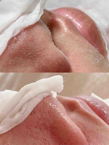 王宥尹美容Spa - 王宥尹美容Spa專業無痛清粉刺前後對比