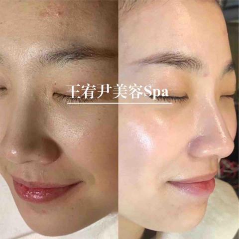 王宥尹美容Spa - 王宥尹美容Spa做臉前後對比