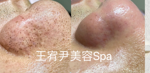 王宥尹美容Spa - 王宥尹美容Spa清鼻頭黑頭前後對比
