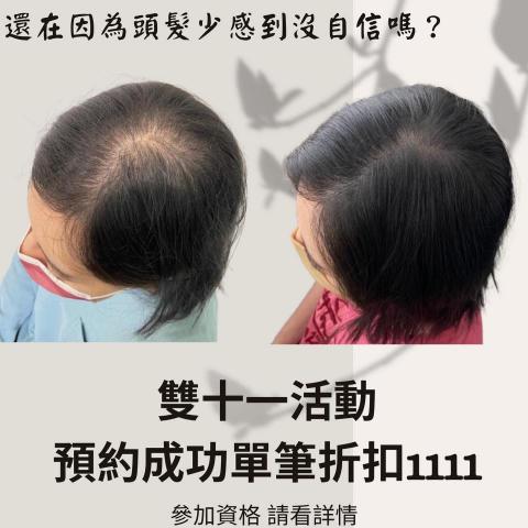 四茂紋髮|英式SMP紋髮|仿針毛囊|頭皮紋髮|落髮改善|疤痕 - 經典案例分享:
▫️頭頂2-3指寬分線
▫️產後落髮
之前與填補之後的樣子真的落差好多,總共施作了三次,記得剛下針的時候客人說好像牙籤在戳癢癢的,一點都不痛,要我放心的去做,還能邊聊天邊施作,真的覺得好優秀??
這個月見面了三次,完成之後看到我們一起滿意的樣子非常的開心還有成就感似乎又添加了一些,謝謝你給我這個機會幫我增加我的作品集,真的是讚讚的天使客人,在這邊跟你說聲感謝 四茂紋髮|英式SMP紋髮|仿針毛囊|頭皮紋髮|落髮改善|疤痕 - 經典案例分享:
▫️頭頂2-3指寬分線
▫️產後落髮
之前與填補之後的樣子真的落差好多,總共施作了三次,記得剛下針的時候客人說好像牙籤在戳癢癢的,一點都不痛,要我放心的去做,還能邊聊天邊施作,真的覺得好優秀??
這個月見面了三次,完成之後看到我們一起滿意的樣子非常的開心還有成就感似乎又添加了一些,謝謝你給我這個機會幫我增加我的作品集,真的是讚讚的天使客人,在這邊跟你說聲感謝
