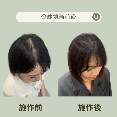 四茂紋髮|英式SMP紋髮|仿針毛囊|頭皮紋髮|落髮改善|疤痕 -  案例分享:分線延續往後腦勺後越加寬大
看照片前後施作真的差!很!大!
除了確實把她原本擔憂的地方填補起來後,另外我自己還幫她把中分線旁分線都一起給補好了,以上這些都是加時不加價的!純粹佛心來著(自己說?) 四茂紋髮|英式SMP紋髮|仿針毛囊|頭皮紋髮|落髮改善|疤痕 -  案例分享:分線延續往後腦勺後越加寬大
看照片前後施作真的差!很!大!
除了確實把她原本擔憂的地方填補起來後,另外我自己還幫她把中分線旁分線都一起給補好了,以上這些都是加時不加價的!純粹佛心來著(自己說?)