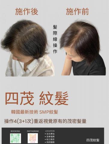 四茂紋髮|英式SMP紋髮|仿針毛囊|頭皮紋髮|落髮改善|疤痕 - 白頭髮一直長出來好困擾
客人因為頭頂上空洞比較大加上是在髮旋的位置,所以長出來的白頭髮很快很快就會覺得頭髮總是空空的,習慣一直補染,染到頭皮都發炎了.
真的非常感謝天使客人每次都特地從桃園坐火車上來,真的是何德何能,就這樣前後紋了三次,看到成果的時候彼此都很滿意,想跟你說辛苦了,從此以後可以好好照顧頭皮了,不用雙週就染一次頭髮,恭喜恭喜?
 四茂紋髮|英式SMP紋髮|仿針毛囊|頭皮紋髮|落髮改善|疤痕 - 白頭髮一直長出來好困擾
客人因為頭頂上空洞比較大加上是在髮旋的位置,所以長出來的白頭髮很快很快就會覺得頭髮總是空空的,習慣一直補染,染到頭皮都發炎了.
真的非常感謝天使客人每次都特地從桃園坐火車上來,真的是何德何能,就這樣前後紋了三次,看到成果的時候彼此都很滿意,想跟你說辛苦了,從此以後可以好好照顧頭皮了,不用雙週就染一次頭髮,恭喜恭喜?