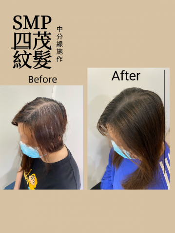 四茂紋髮|英式SMP紋髮|仿針毛囊|頭皮紋髮|落髮改善|疤痕 - 體驗部位:中分線+後腦勺(T字部位)
本人有填滿的強迫症,所以自己施作的範圍一直越來越大越來越大,這些都是額外免費贈送的?
施作完當下真的滿滿成就感,SMP紋髮可以維持5-8年,再毛囊與毛囊之間施針,不會傷害毛囊,也沒有修復期,馬上做完當下就看到效果了,而且可以直接出門!又是個成就感滿滿的一天。
 四茂紋髮|英式SMP紋髮|仿針毛囊|頭皮紋髮|落髮改善|疤痕 - 體驗部位:中分線+後腦勺(T字部位)
本人有填滿的強迫症,所以自己施作的範圍一直越來越大越來越大,這些都是額外免費贈送的?
施作完當下真的滿滿成就感,SMP紋髮可以維持5-8年,再毛囊與毛囊之間施針,不會傷害毛囊,也沒有修復期,馬上做完當下就看到效果了,而且可以直接出門!又是個成就感滿滿的一天。