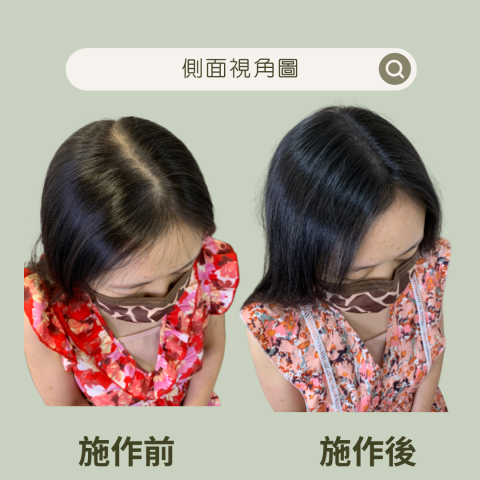 四茂紋髮|英式SMP紋髮|仿針毛囊|頭皮紋髮|落髮改善|疤痕 -  案例分享:中分線延續到後腦勺
第一次見面的時候肉眼看還非常的清楚
整條分線延續到後腦勺去 從背影看都很明顯看得到空
洞
我直接跟她說這種真的很適合紋髮 交給我們就對了
經過三次的紋髮真的可以明顯感受到差!超!多!
以後再也不必煩惱與憂愁了
變得更水水才能賺更多的錢 四茂紋髮|英式SMP紋髮|仿針毛囊|頭皮紋髮|落髮改善|疤痕 -  案例分享:中分線延續到後腦勺
第一次見面的時候肉眼看還非常的清楚
整條分線延續到後腦勺去 從背影看都很明顯看得到空
洞
我直接跟她說這種真的很適合紋髮 交給我們就對了
經過三次的紋髮真的可以明顯感受到差!超!多!
以後再也不必煩惱與憂愁了
變得更水水才能賺更多的錢