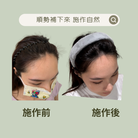 四茂紋髮|英式SMP紋髮|仿針毛囊|頭皮紋髮|落髮改善|疤痕 -  額角總是缺少一塊好困擾‼️
每次綁頭髮或是往後梳總是無法有順順的髮流,總是禿了一小角.
經過溝通後,她希望可以幫她缺少的那一塊填補起來,讓她的髮流近看與遠看都看起來更順就好了.
於是我們討論好了施作部位+她想要的髮流開始施作.
填補的過程之中我們幾乎是邊施作邊討論,她改一點我跟著修一點,完成之後彼此都非常滿意與自然.
照片每一個視角圖都看得出來流暢了許多解決了二十幾年以來的煩惱‼️ 四茂紋髮|英式SMP紋髮|仿針毛囊|頭皮紋髮|落髮改善|疤痕 -  額角總是缺少一塊好困擾‼️
每次綁頭髮或是往後梳總是無法有順順的髮流,總是禿了一小角.
經過溝通後,她希望可以幫她缺少的那一塊填補起來,讓她的髮流近看與遠看都看起來更順就好了.
於是我們討論好了施作部位+她想要的髮流開始施作.
填補的過程之中我們幾乎是邊施作邊討論,她改一點我跟著修一點,完成之後彼此都非常滿意與自然.
照片每一個視角圖都看得出來流暢了許多解決了二十幾年以來的煩惱‼️