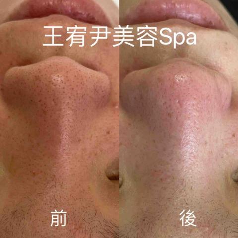 王宥尹美容Spa - 王宥尹美容Spa清粉刺前後對比