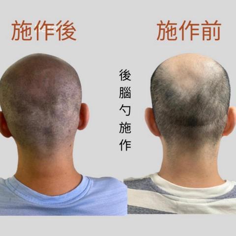 四茂紋髮|英式SMP紋髮|仿針毛囊|頭皮紋髮|落髮改善|疤痕 - 案例分享:後腦勺施作
總是頂著大光頭嗎?四茂紋髮徵的就是你,型男平頭改造中,幫你搖身一變成為具俊燁帥哥。施作前後自然看不出任何刻意的痕跡就是SMP紋髮的厲害,這次也幫大哥解決了多年以來的困擾,他再也不用頂著帽子出門了,可以順利帥氣轉身,你也有這個困擾嗎?跟我們預約諮詢吧。 四茂紋髮|英式SMP紋髮|仿針毛囊|頭皮紋髮|落髮改善|疤痕 - 案例分享:後腦勺施作
總是頂著大光頭嗎?四茂紋髮徵的就是你,型男平頭改造中,幫你搖身一變成為具俊燁帥哥。施作前後自然看不出任何刻意的痕跡就是SMP紋髮的厲害,這次也幫大哥解決了多年以來的困擾,他再也不用頂著帽子出門了,可以順利帥氣轉身,你也有這個困擾嗎?跟我們預約諮詢吧。