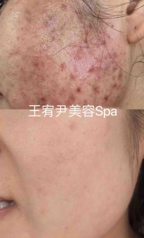 王宥尹美容Spa - 痘痘痘疤肌膚保養前後對比