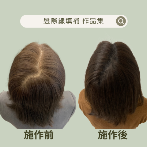 四茂紋髮|英式SMP紋髮|仿針毛囊|頭皮紋髮|落髮改善|疤痕 - ⚠️因髮旋位置靠近後腦勺,頭髮沒吹好分線明顯就像後腦勺開花!
⚠️每次拍照都擔心分線有沒有分好,那條線會不會又跑出來!
⚠️那條線是不是看起來像頭髮很少,間接自我懷疑是否有落髮問題!
客戶反饋
?沒想到對比之後差那麼多,看起來茂密,出門不擔心後腦勺那條線,解決這幾年對髮旋位置很不滿意的問題,終於不會再看不順眼,因爲看不到了,很開心? 四茂紋髮|英式SMP紋髮|仿針毛囊|頭皮紋髮|落髮改善|疤痕 - ⚠️因髮旋位置靠近後腦勺,頭髮沒吹好分線明顯就像後腦勺開花!
⚠️每次拍照都擔心分線有沒有分好,那條線會不會又跑出來!
⚠️那條線是不是看起來像頭髮很少,間接自我懷疑是否有落髮問題!
客戶反饋
?沒想到對比之後差那麼多,看起來茂密,出門不擔心後腦勺那條線,解決這幾年對髮旋位置很不滿意的問題,終於不會再看不順眼,因爲看不到了,很開心?