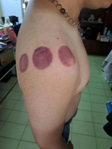 文偲宇養生整復 - 到府整復調理，針對50肩的處理