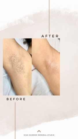 High Summer工作室 - 腋下除毛