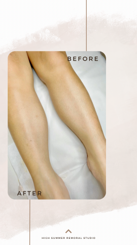 High Summer工作室 - 小腿除毛