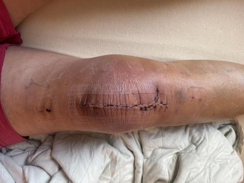 林美瑩 - 68歲婦人、換人工關節第三天後行走自如、順利出院！