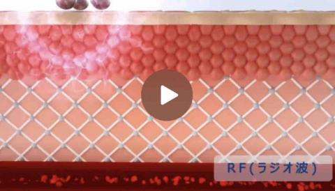 23D動畫影片剪輯建模設計接急件 - 醫美設備3D影片https://reurl.cc/WvMG45