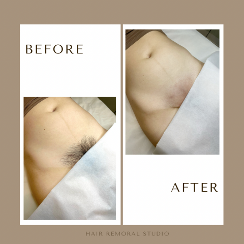 High Summer工作室 - 私密處全除