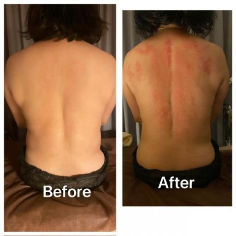 Linda - 女顧客為職業婦女，長期坐辦公桌，腋下腫脹，背都循環不好，背腰酸痛。
做排酸療法，讓身體循環變佳，背部曲線也變好了。